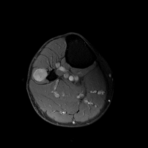 Figure 6 for case Schwannoma ( RID4473 )